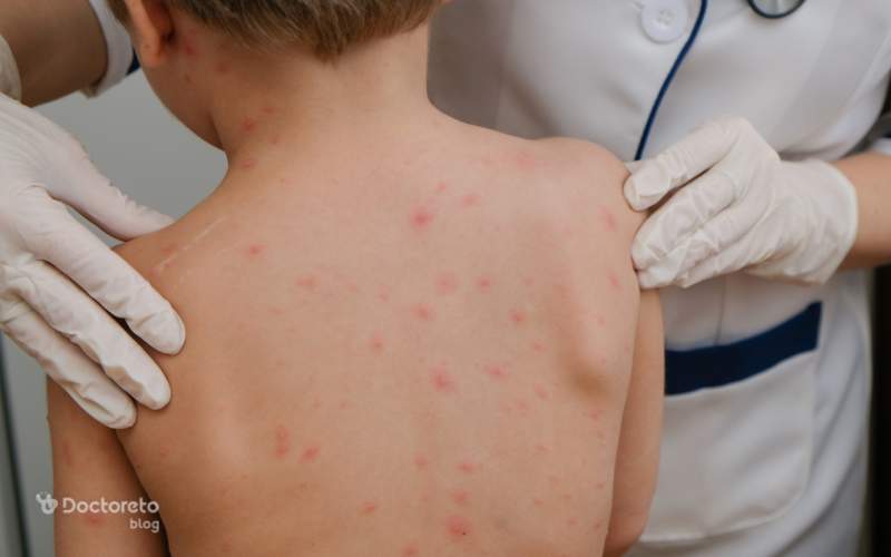 جای آبله مرغان چگونه است؟