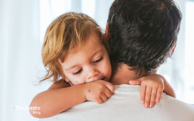 در فصل شیوع آبله مرغان چه اقداماتی برای پیشگیری در کودکان لازم است؟