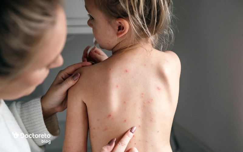 ممکن است همزمان آبله مرغان و واکنش آلرژیک داشته باشم؟