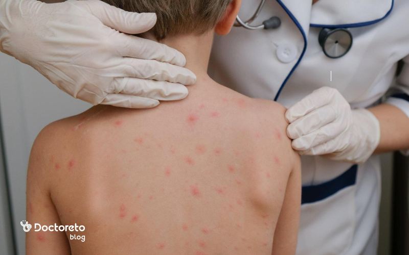 آیا آبله مرغان بیماری کشنده است؟