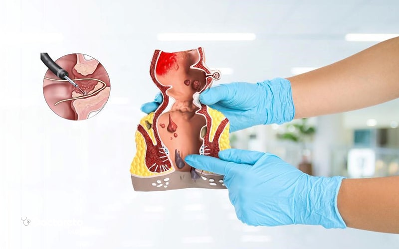 ایجاد فرورفتگی یا سوراخ کوچک روی پوست علت فیستول مویی است.