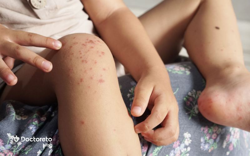 تب برفکی در کودکان خطرناک است؟