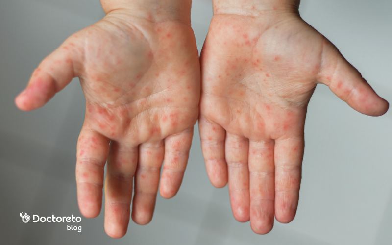 تب برفکی در انسان خطرناک است؟