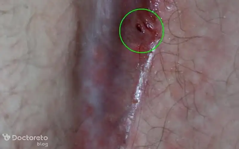 فیستول مویی چگونه درمان میشود؟