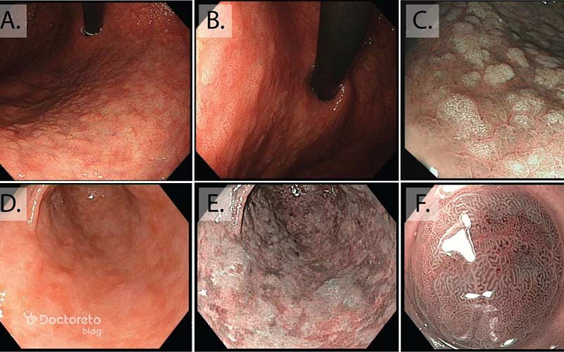 سرطان معده بدخیم در مراحل اولیه دارای چنین ظاهر و بافتی هستند.