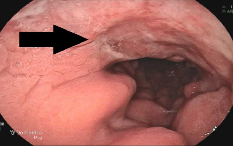 عکس زخم سرطان معده بدخیم بدین شکل است.