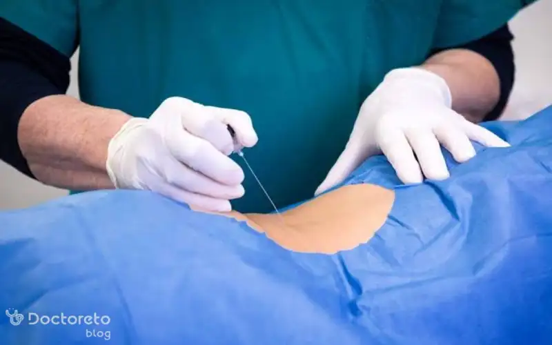 احتیاطات پیش از جراحی فیستول به روش vaaft چیست؟