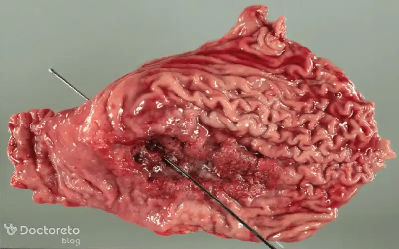 عکس سرطان معده بدخیم بدین شکل است.