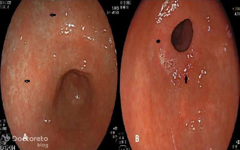 عکس سرطان معده بدخیم در مراحل اولیه بدین شکل است.