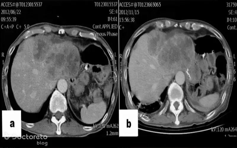 عکس سرطان معده بدخیم در مراحل پیشرفته بدین شکل است.