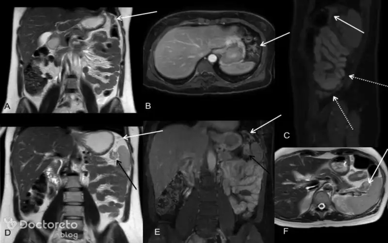 عکس تصویربرداری های سرطان معده بدخیم بدین شکل است.