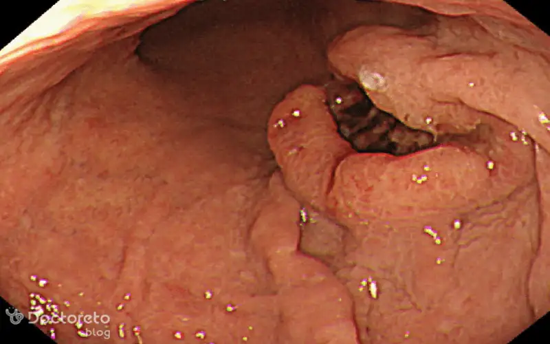 عکس آندوسکوپی سرطان معده بدخیم بدین شکل است.