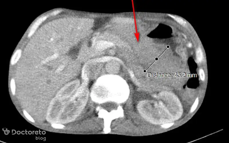 عکس سی تی اسکن سرطان معده بدخیم نشان دهنده چیست؟