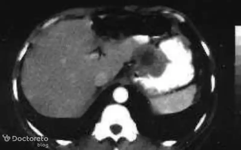 عکس سرطان معده خوش خیم بدین شکل است.