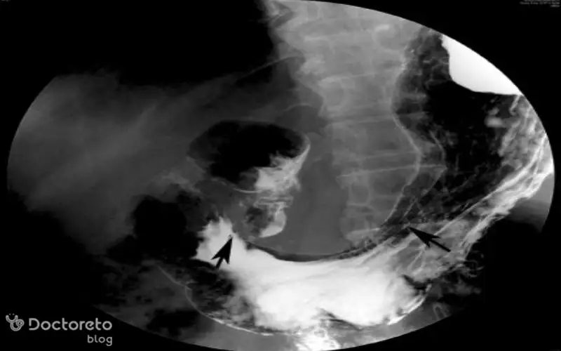 عکس تصویربرداری های سرطان معده خوش خیم بدین شکل است.