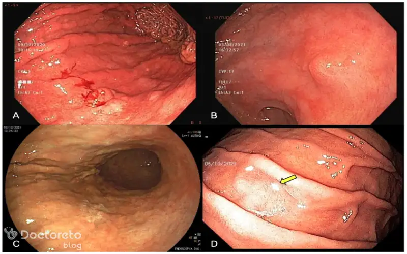 عکس آندوسکوپی سرطان معده خوش خیم بدین شکل است.