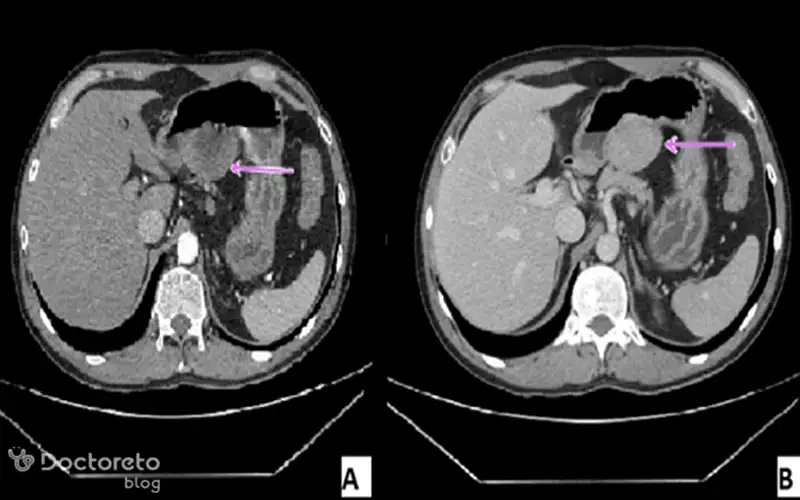 عکس سی تی اسکن سرطان معده خوش خیم بدین شکل است.