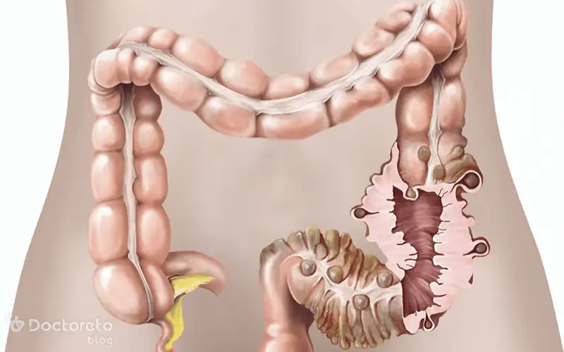 جراحی از روشهای درمان دیورتیکولیت است.