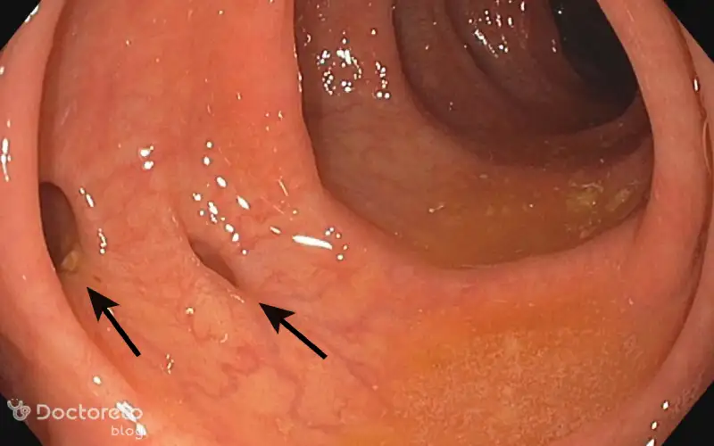 دیورتیکولیت چیست؟