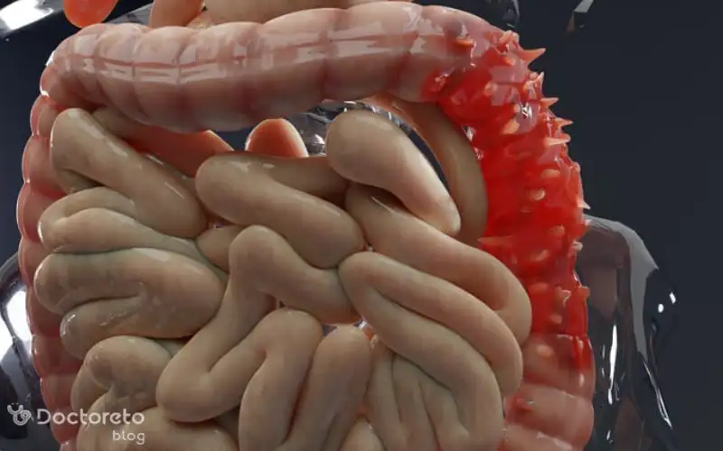 بیماری دیورتیکولیت چگونه است؟