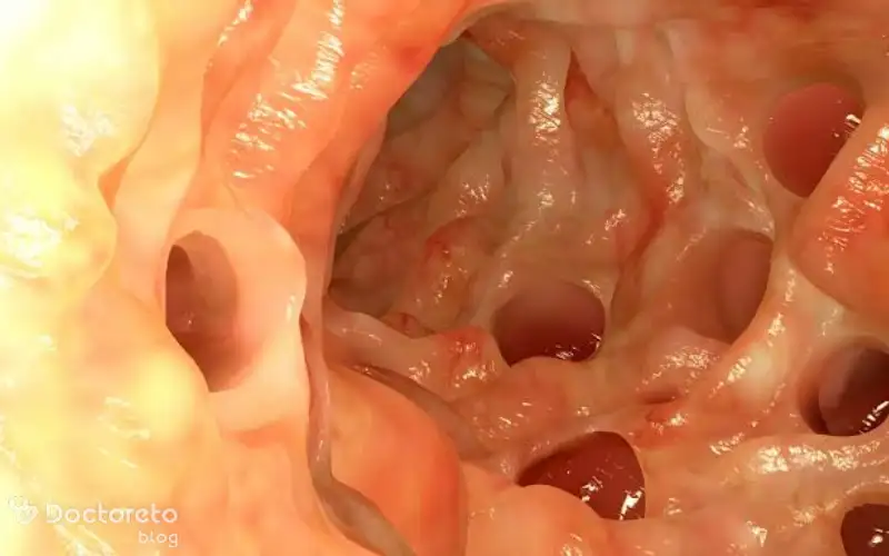 درمان دارویی دیورتیکولیت چقدر موثر است؟