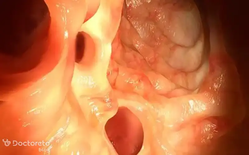 بیماری دیورتیکولیت چه نشانه هایی دارد؟