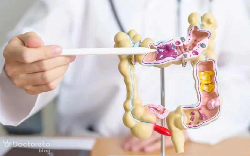 خونریزی از مقعد یا خون در مدفوع (خونریزی از راست روده) از علائم دیورتیکولیت