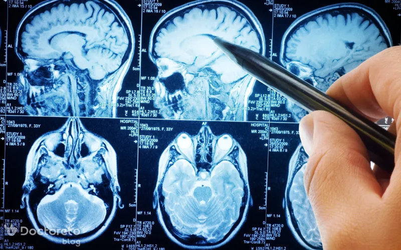 دیدن جرقههای نوری یا سایههای کوتاه مدت از نشانههای ام اس خاموش است.