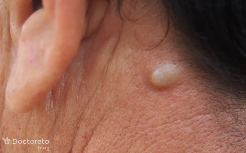 کیست گردن خطرناک است؟