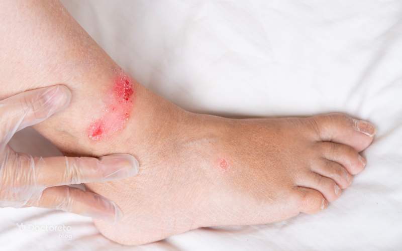 انواع عفونت زخم پای دیابتی وجود دارد.