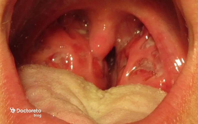 تفاوت های ورم لوزه سمت چپ با ورم لوزه دو طرفه در چیست؟