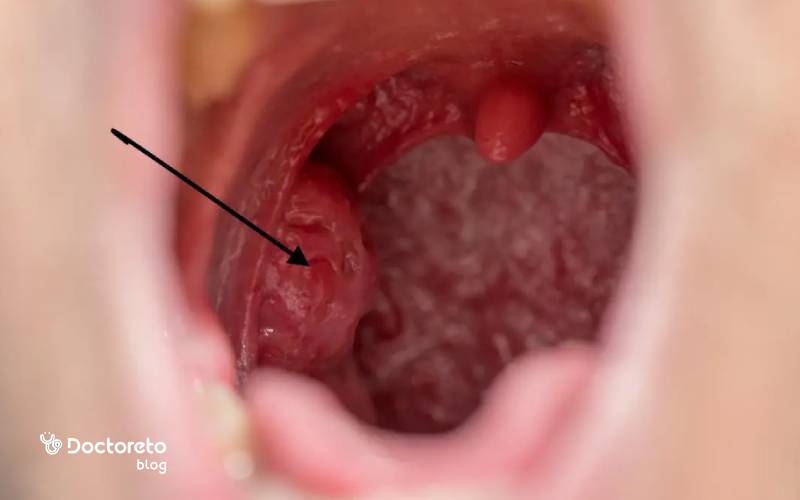 درمان ورم لوزه سمت چپ چگونه است؟