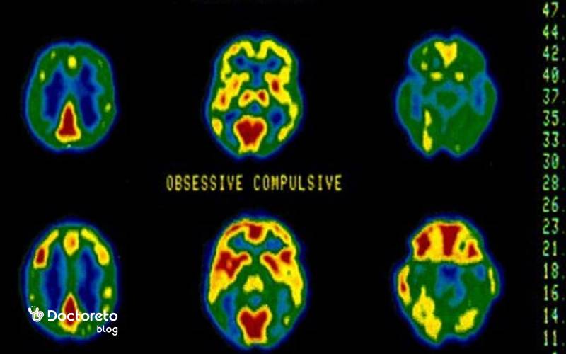 الگوهای شایع امواج مغزی در وسواس چگونه است؟