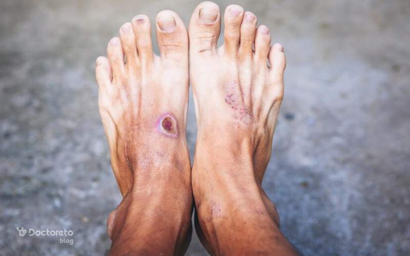 زخم پای دیابتی چند نوع است؟