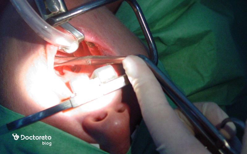 آیا عمل لوزه سوم درد دارد؟