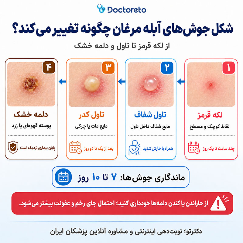 اینفوگرافی شکل جوشهای ابله مرغان