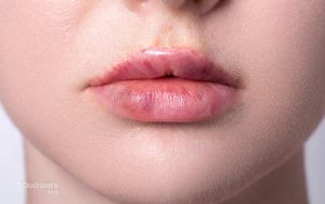 کبودی لب و تمام آنچه باید درباره علل آن بدانید