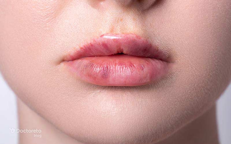 علت کبودی لب چیست؟
