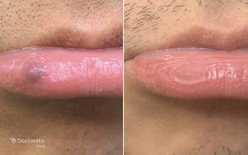 چگونه کبودی لب برطرف میشود؟