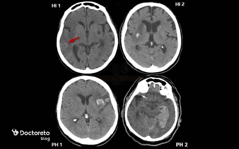 نمره GCS (خفیف، متوسط، شدید) چگونه تفسیر می شود؟