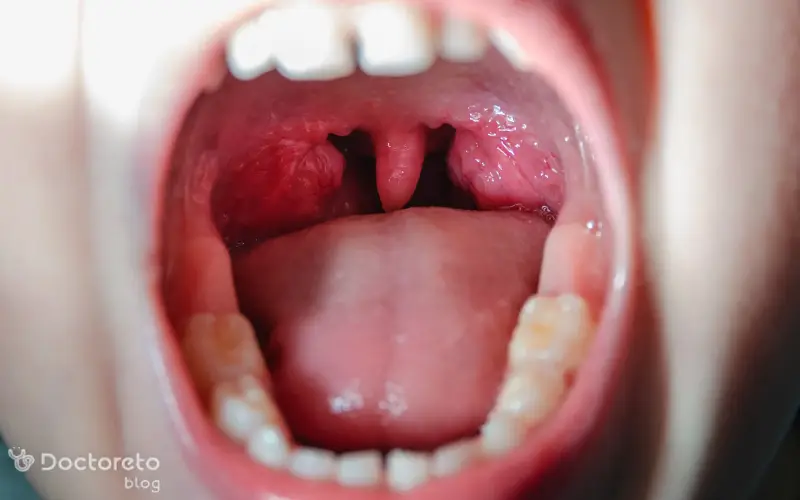 عکس لوزه چه شکلی است؟