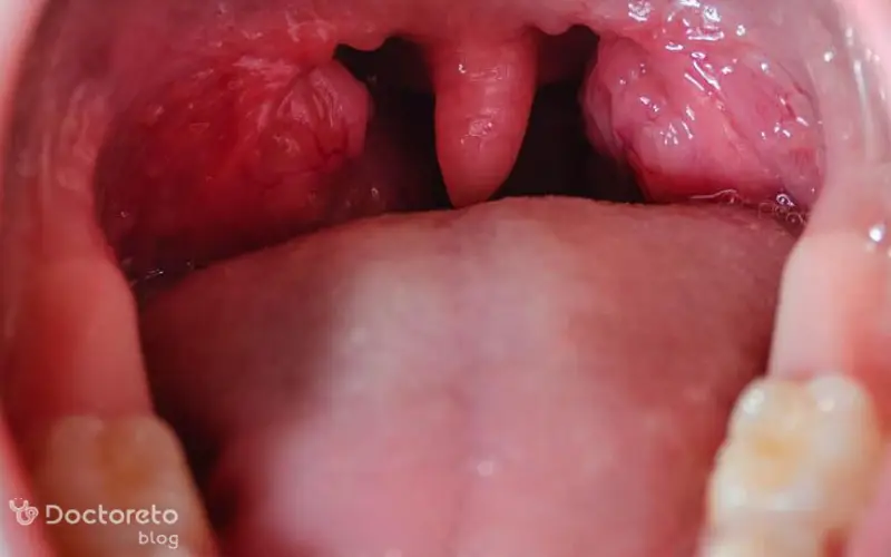 تصویر لوزه طبیعی بدین شکل است.