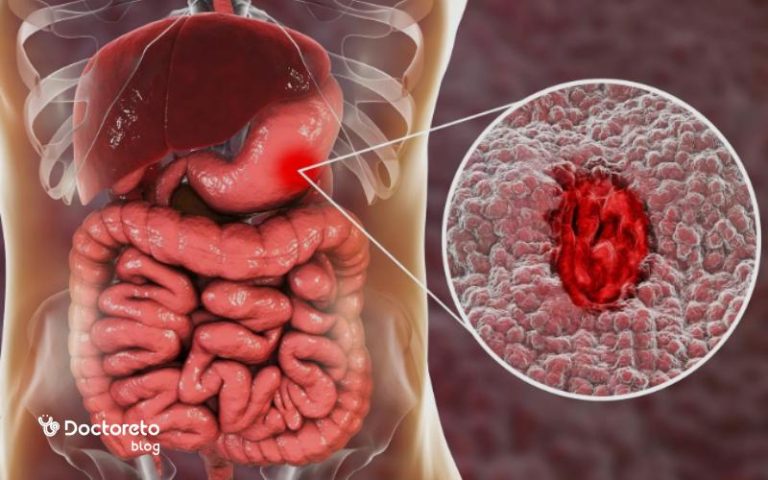 انواع خونریزی دستگاه گوارش چه علت و راه درمانی دارد؟