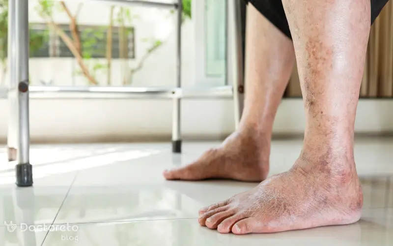 عکس زخم پای دیابتی