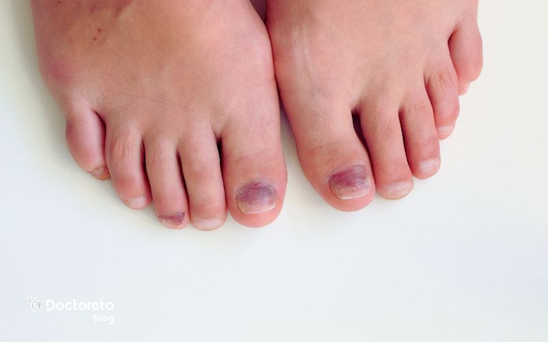 چه زمانی باید برای لکه ناخن به پزشک مراجعه کرد؟