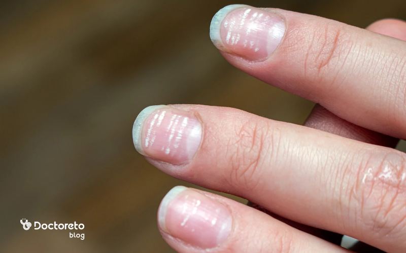 درمان قطعی لکه روی ناخن چیست؟