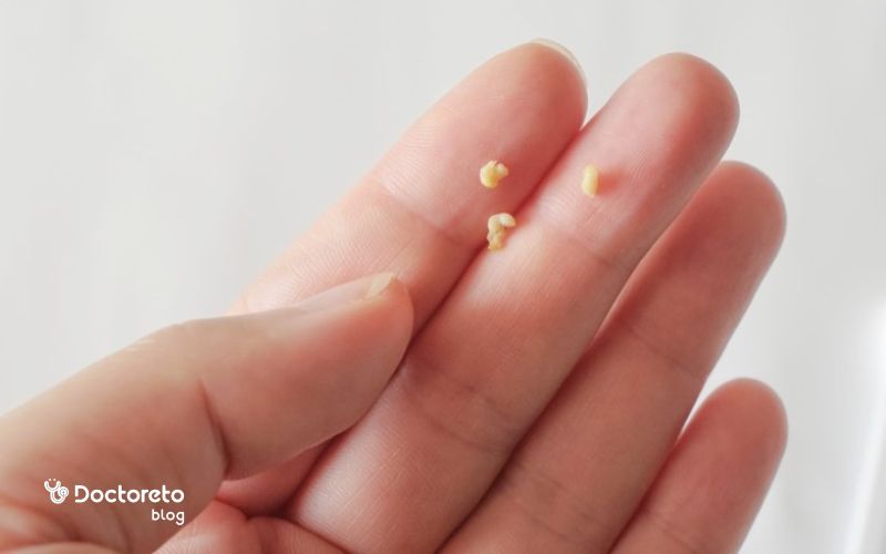 سنگ لوزه چه شکلی است؟