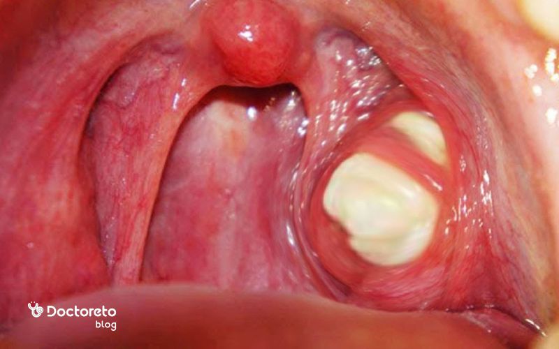 عکس سنگ لوزه در دهان از نمای نزدیک چگونه است؟