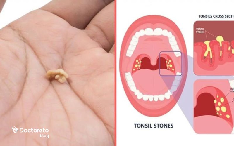عکس قبل و بعد از خارج کردن سنگ لوزه چگونه است؟