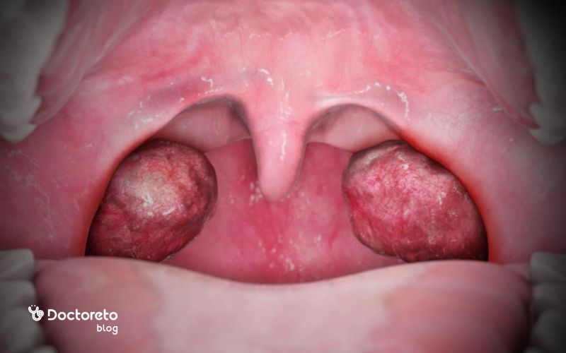 عکس سنگ لوزه چگونه است؟